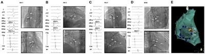 Outcomes of Different Ablation Approaches for Para-Hisian Accessory Pathway and Ablation Safety at Each Site